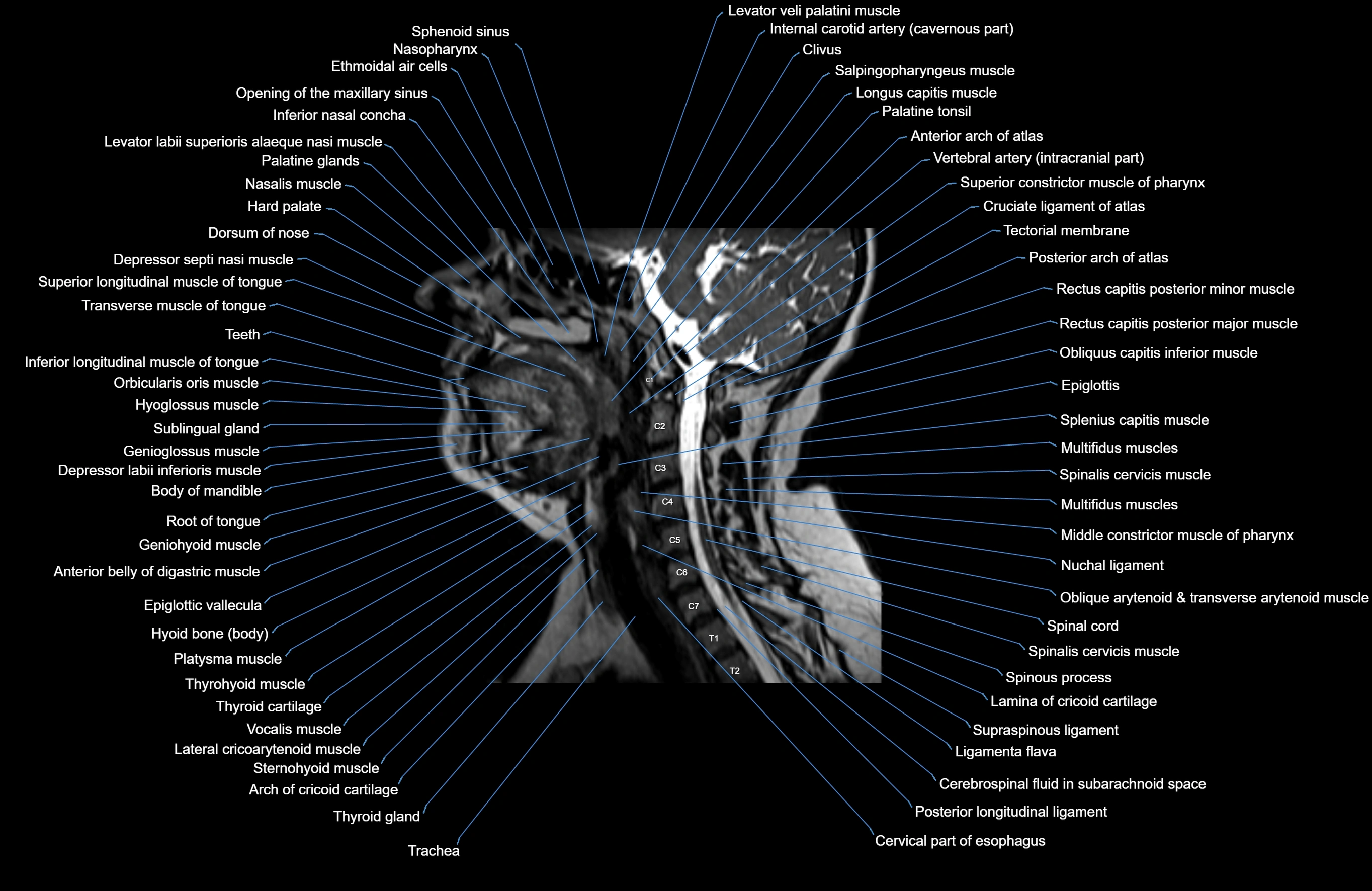Neck MRI sagittal cross sectional anatomy 3D 1mm 3T radiology  image-img-00001-00008.webp